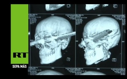 Una barra de 30 cm le atraviesa el cráneo y sobrevive
