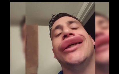 Le pica una avispa en la boca y dedica un video a quienes se aumentan los labios